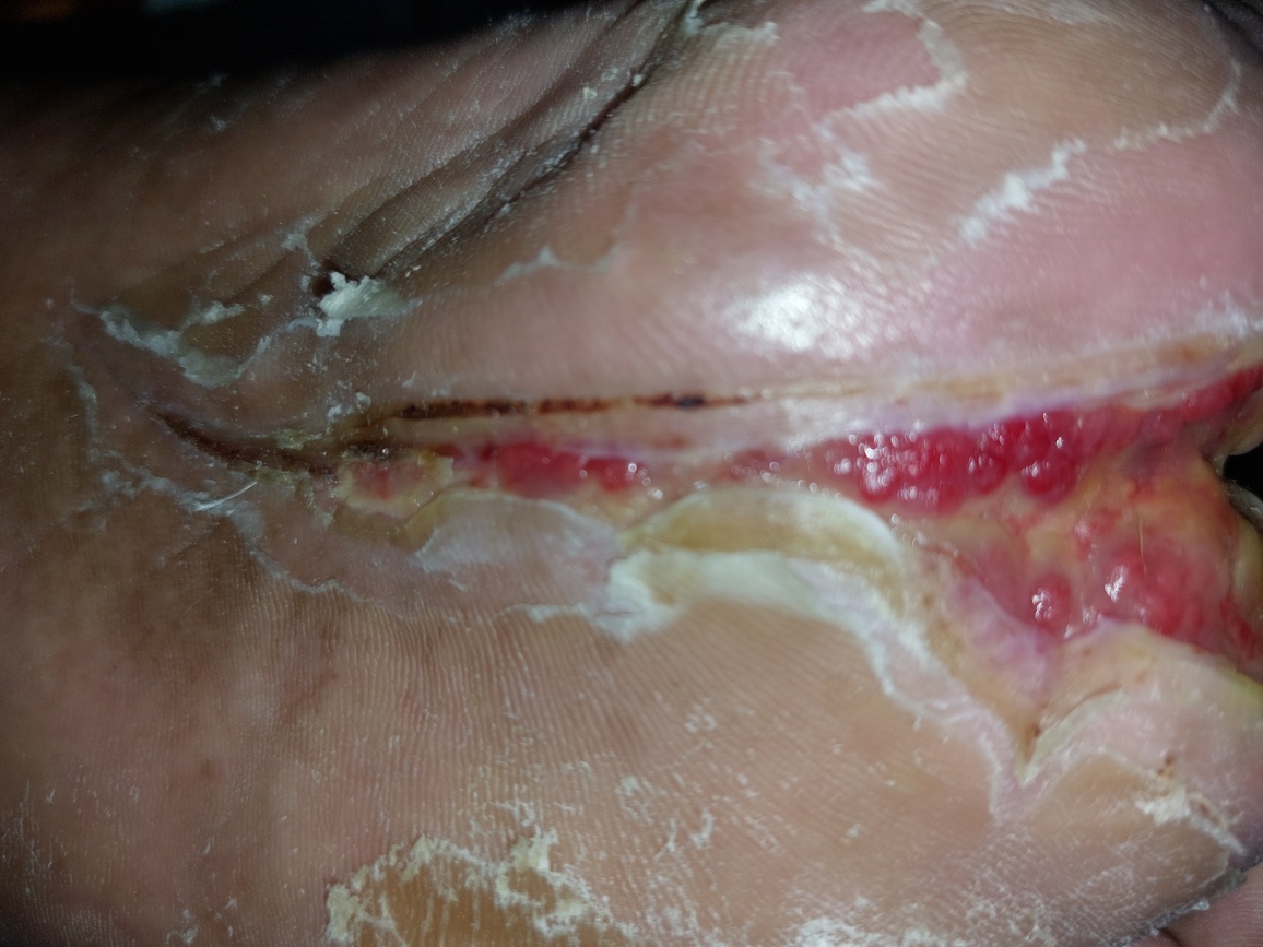 Wound progress